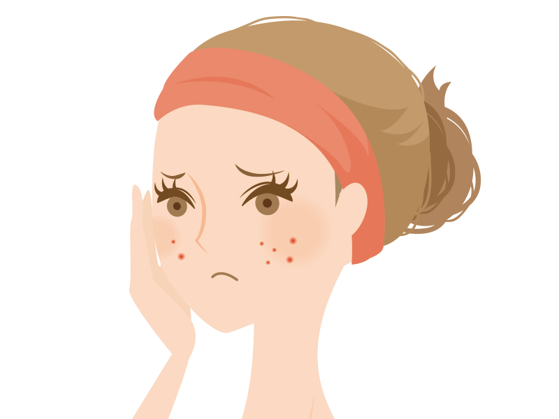 ニキビ治療